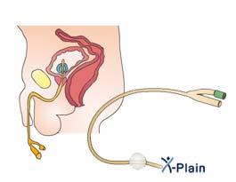 Removal of the indwelling catheter after