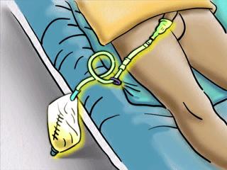 Patients with urethral catheters in place for