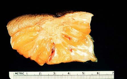 Typical gross appearance of invasive ductal carcinoma.