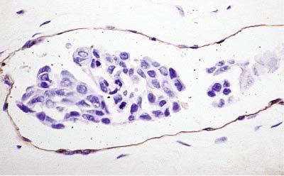 Vascular invasion by breast carcinoma demonstrated by