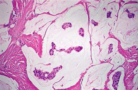 Mucinous carcinoma of the breast.