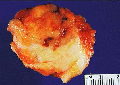 Gross appearance of medullary carcinoma.