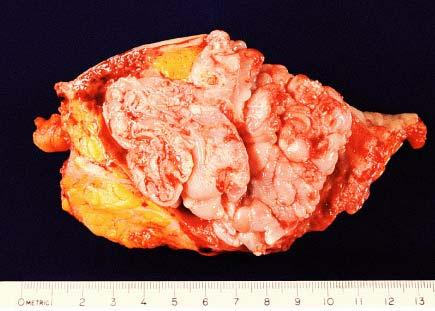 Gross appearance of metaplastic carcinoma.