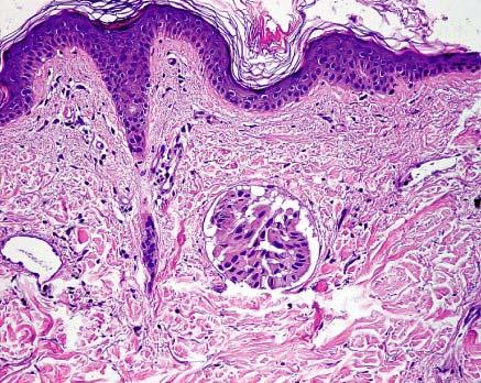 Large tumor embolus in a dermal lymph vessel in a case