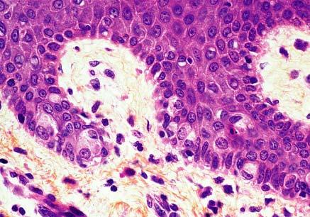 Biopsy of nipple showing scattered clear cells in the basal layer ( Toker s cells ).