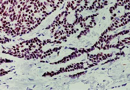 Immunocytochemical stain for estrogen receptors in invasive breast carcinoma.