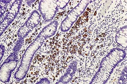 Metastasis of mammary lobular carcinoma to lamina
