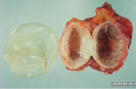 Breast implant (left) surrounded by a thick fibrous