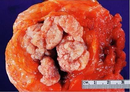 Gross appearance of phylloides tumor.