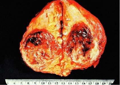 Gross appearance of phylloides tumor.