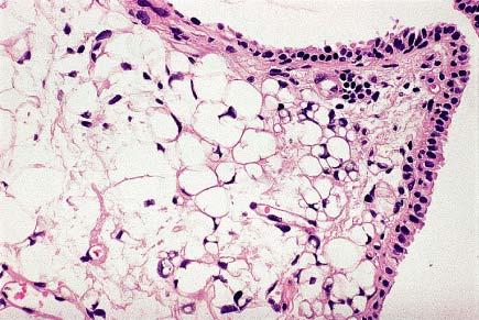 Phylloides tumor with adipose tissue