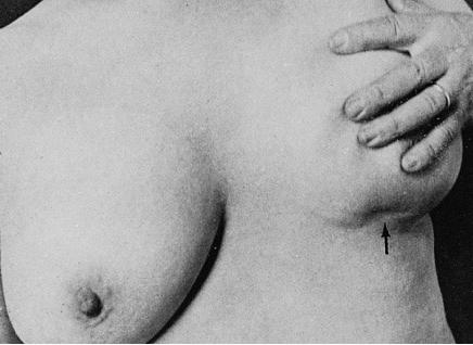 Retraction of skin in a patient with fat necrosis