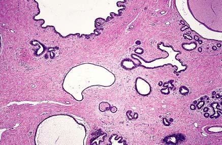 Glandular epithelium and fibrous stroma with