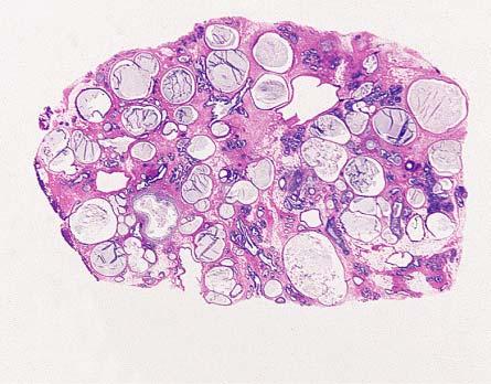 Juvenile papillomatosis (Swiss cheese disease).