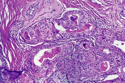 Carcinoma of the male breast composed of welldifferentiated tumor