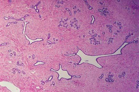 Microscopic appearance of fibroadenoma.