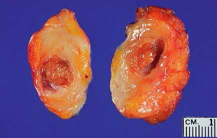 Gross appearance of intraductal papilloma.