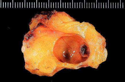 Gross appearance of papilloma