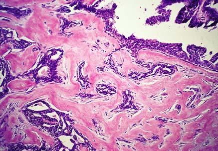 Papilloma of breast showing entrapment of epithelial structures