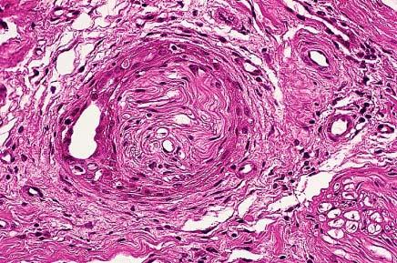 Benign perineurial invasion in a breast lesion that