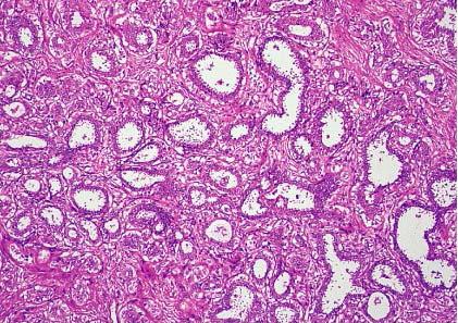 Adenomyoepithelial adenosis.. The glands are relatively large, with a wide, open lumen and apocrine metaplasia.