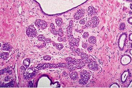 Two different breast lesions diagnosed as atypical lobular hyperplasia by four experts in breast pathology.