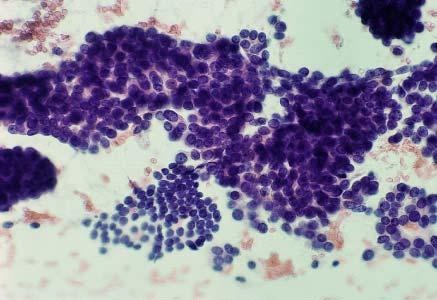 Cytologic features of various types of breast lesions