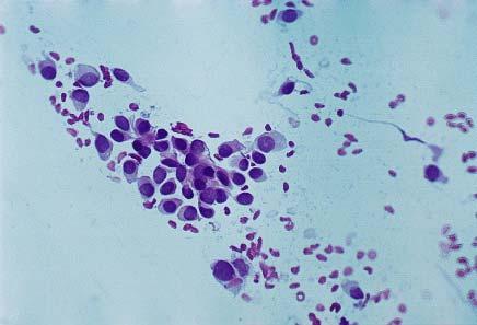Cytologic features of various types of breast lesions