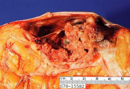 Intracystic carcinoma of the breast.