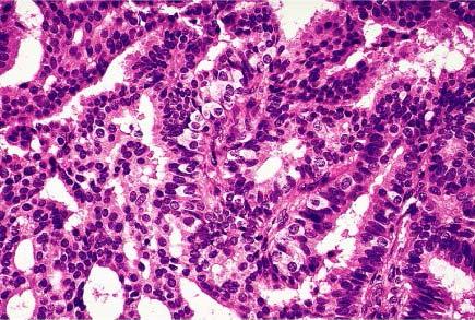 Papillary carcinoma with so-called globoid or clear cells.