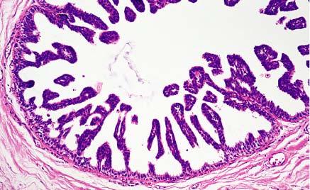 Micropapillary carcinoma of breast.