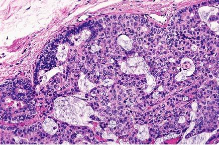 Endocrine-type ductal carcinoma in