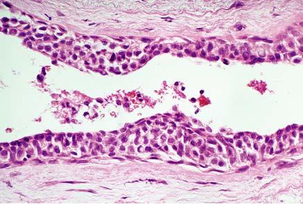 Involvement of duct by lobular carcinoma in situ.