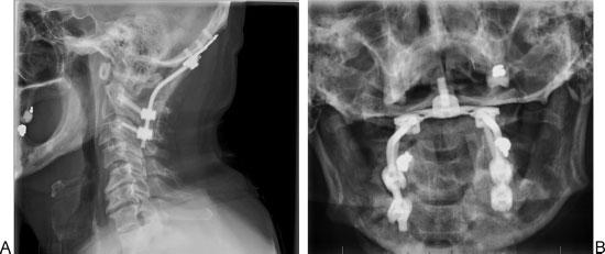 Vertebral Artery Anomalies at the Craniovertebral Junction Abtahi et al. 123 Fig. 3 (A, B) Anteroposterior open mouth and lateral postoperative radiographs showing occiput C3 fusion construct.