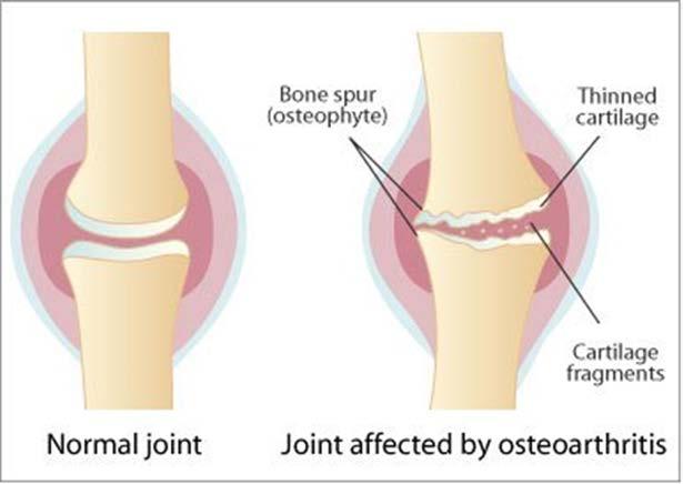 Common Types of Arthritis Arthritis can be broken down into three main categories. Here are some of the most common types: Osteoarthritis (OA).