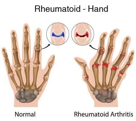 RA is an autoimmune disease that usually strikes between the ages of 30 and 50. Women are most often affected, though children may also develop RA. Juvenile arthritis (JA).
