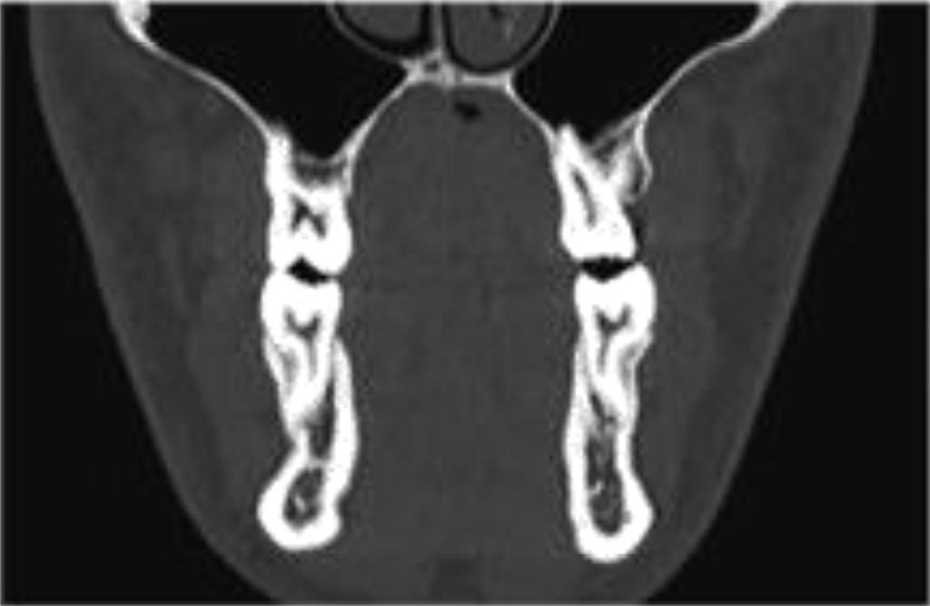 B. DUCROZ, D. BREZULIER, V. BERTAUD-GOUNOT, O. SOREL Figure 8 CT scan at the level of the first molars.