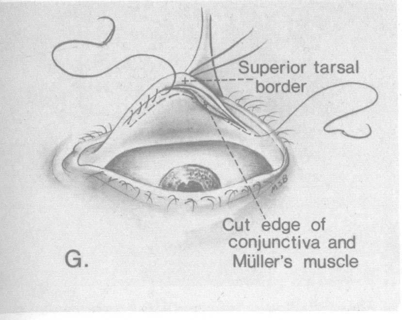 1B). (This manoeuvre is possible because Miillers muscle is firmly attached to conjunctiva but only loosely attached to the levator aponeurosis.