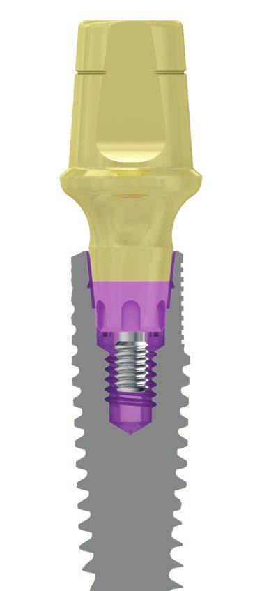Engineered for bone stress reduction The gaps around the sides of the implant neck were designed to result in an open, compressionfree zone.