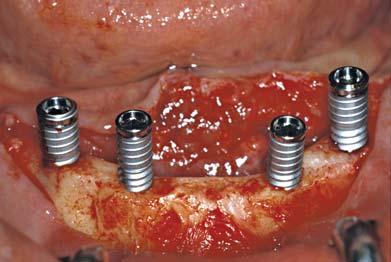 3 distal Implant inserted partially by the implant carriers 7 8 9 Ratchet and Hexed Implant