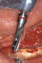 The site can be flushed with normal saline and isolated before placement of the implant.