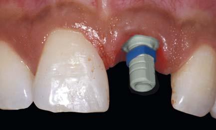 (single tooth with custom healing Biotemp abutment) pilot drill