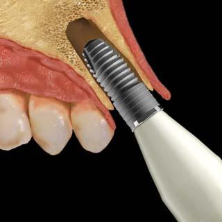 D 5.3mm drill in the same axis without touching the buccal cortical