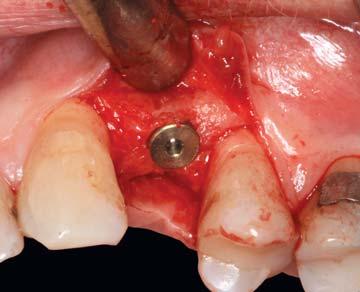 implant contact that translates to enhanced osseointegration values.