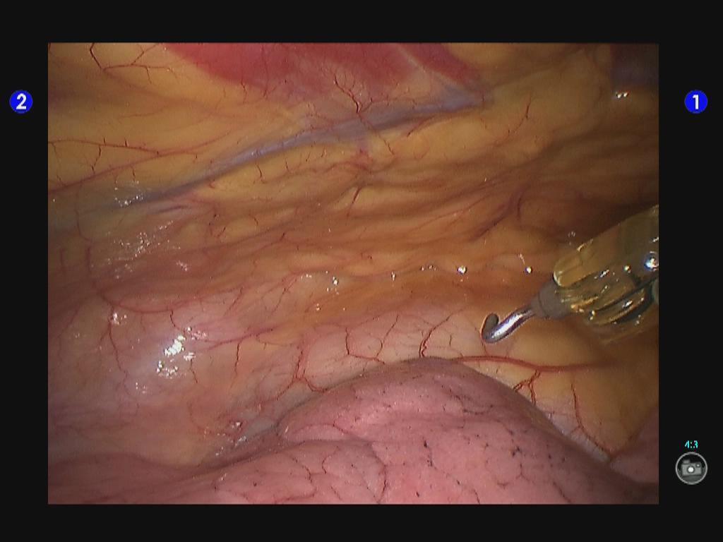 Figure 6 Cut open the mediastinal pleura front of phrenic nerve.