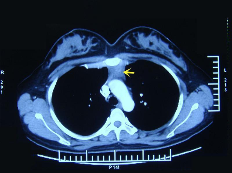 thymus till the left upper lobe of thymus. Thus, the left lobe of thymus was divided (Figures 12-14).