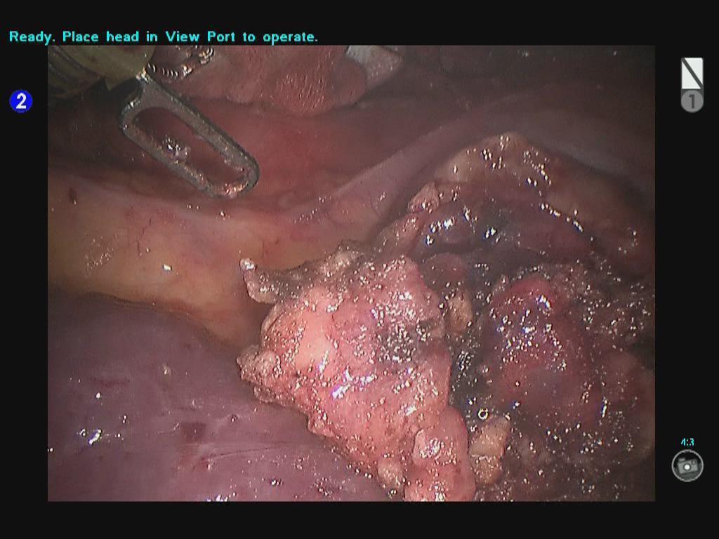 The thoracic drainage tube was indwelled at the camera port before closing the chest. Figure 19 Inspection showed that there was no obvious bleeding or exudate on the wound surface.