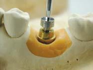 Safe abutment Step4 Wax up Safe abutments D H 4 5.5 7mm G/H Resin build up Full wax up 4 5.