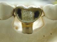 Tightening torque = 30Ncm Tightenng the implant and abutment