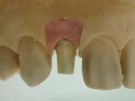 0 After customizing the ZioCera abutment when the space left between the opposing tooth and